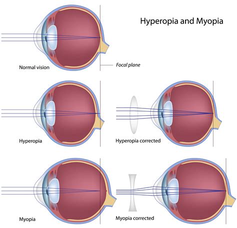h52 1 miyopi h52 2 astigmatizma ne demek